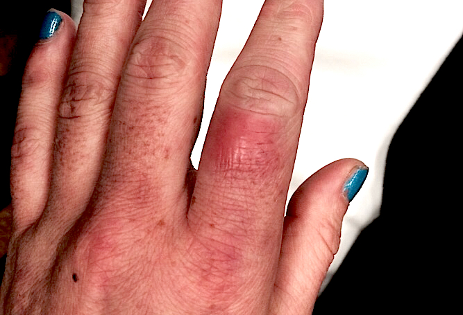 Cellulitis Hand Surgery Resource